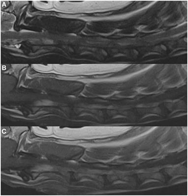 Bilateral Vertebral Venous Sinus Thrombosis Causing Cervical Spinal Cord Compression in a Dog